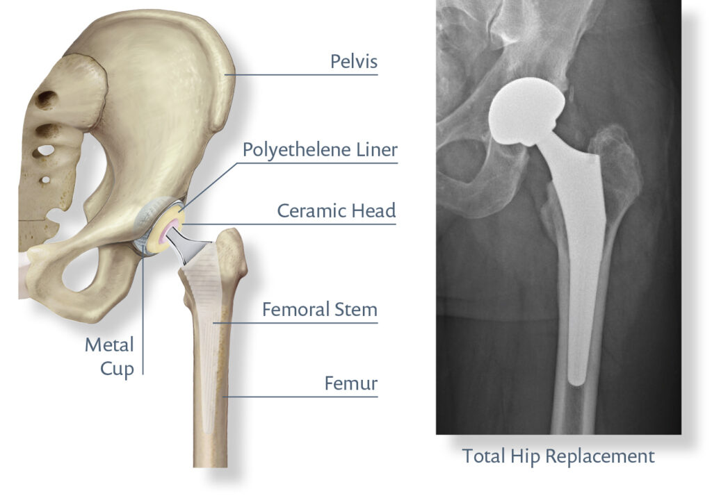 Total Hip Replacement Surgeons Perth Dr Daniel Fick Total Hip Replacement Surgeons Perth Dr Daniel Fick