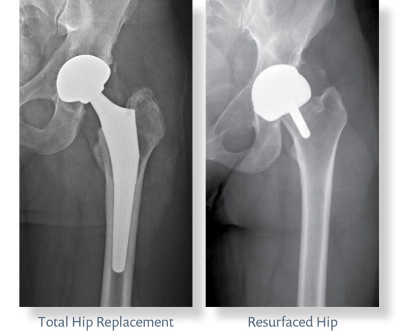 Total Hip Replacement Xrays