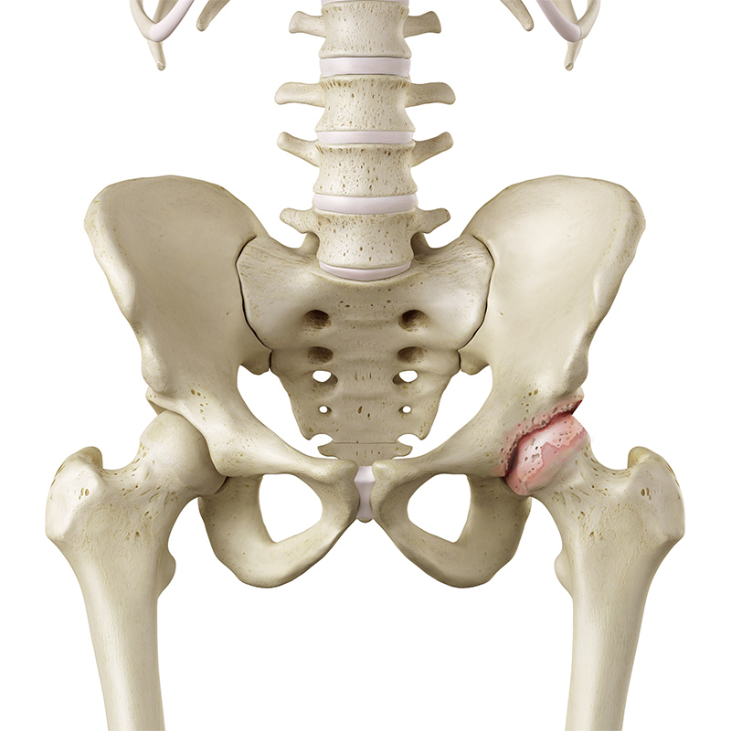 Hip with Arthritis