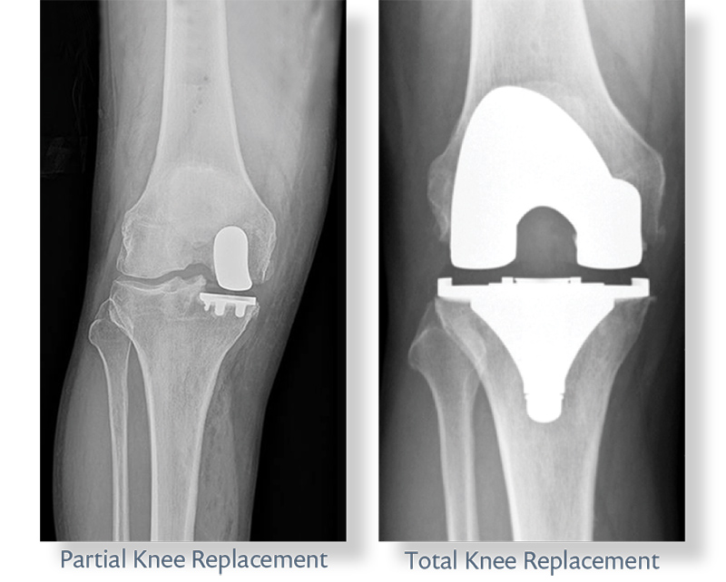 Partial knee xray
