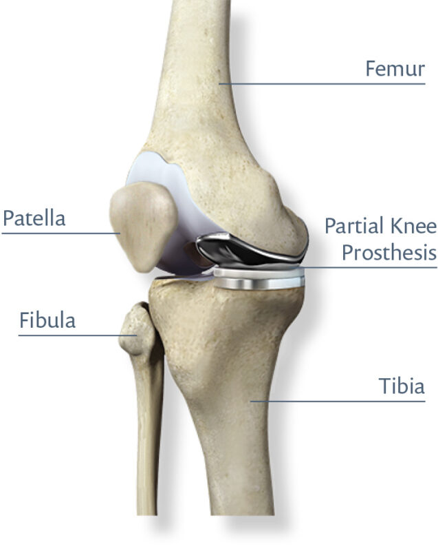 Partial knee replacement diagram