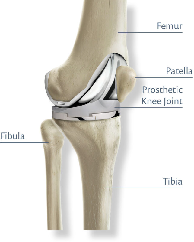 Total knee replacement diagram