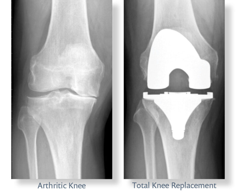 Total knee replacement xrays